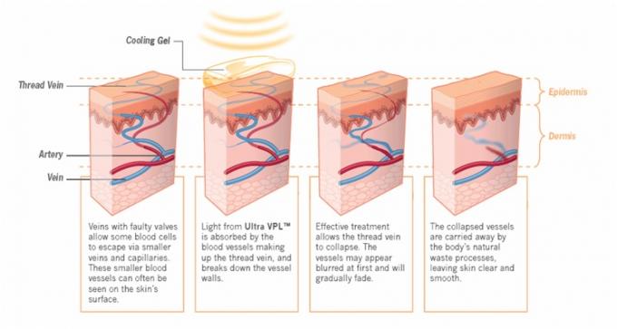Máquinas del retiro del pelo del retiro IPL de la arruga con tecnología variable del pulso